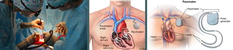 Heart Pacemaker Surgery in Dombivli (Call: 9870270751)- Heart Pacemaker Surgery in Kalyan