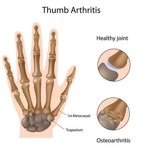 Common Thumb Injuries - My Family Physio