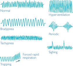 Bradypnea | definition of bradypnea by Medical dictionary