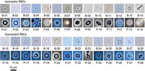 Isomorphic red blood cells (RBCs) and dysmorphic RBCs, 400×. B: bright ...