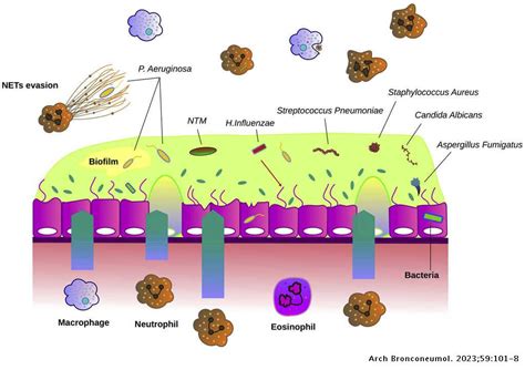 Pathophysiology of Chronic Bronchial Infection in Bronchiectasis | Archivos de Bronconeumología