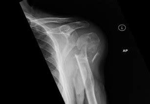 xr-JF Before Surgery for Shoulder Fracture - view2 - Offering unparalleled orthopaedic ...