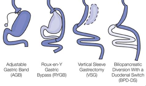 The 4 Most Common Types of Bariatric Surgery - BariatricBuzz