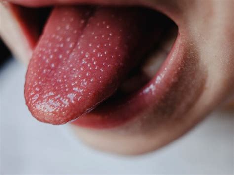 Transient Lingual Papillitis