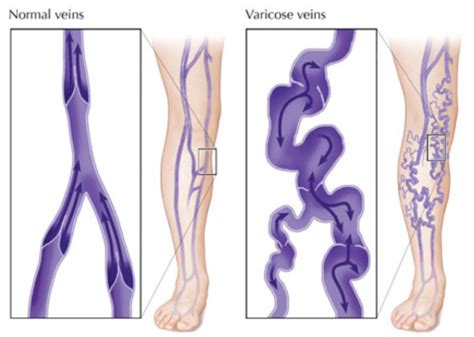 Function Of Venous Valves