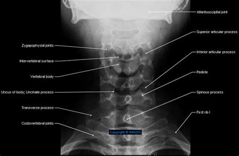 Radiographic positioning: Cervical x-ray