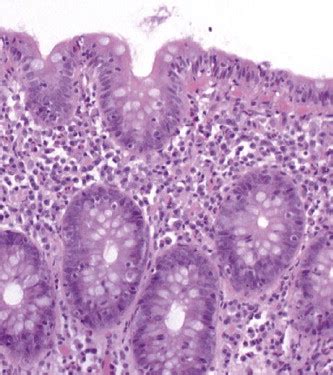 Microscopic colitis - Medicine