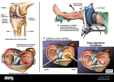 Lateral meniscus tear hi-res stock photography and images - Alamy