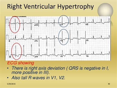 Role of ecg in pulmonology