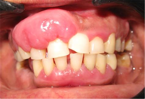 Extramedullary plasmacytoma of the gingiva | BMJ Case Reports