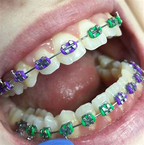 girl purple braces – Braces Explained