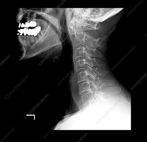 Severe Fracture of the Cervical Vertebrae - Stock Image - M330/1253 - Science Photo Library