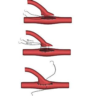 Vascular Anastomosis