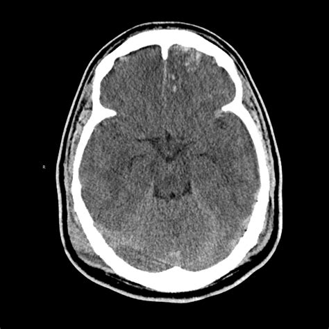 Pediatric Cerebral Contusion | Pediatric Radiology Reference Article ...