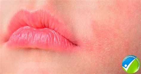 Itchy Burning Lips: 7 Natural Remedies to Try at Home