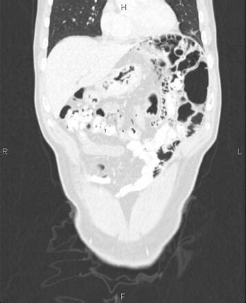 Benign pneumatosis coli | Radiology Case | Radiopaedia.org