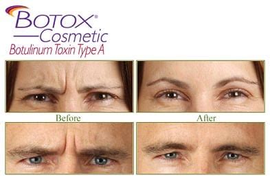 Botox & Restylane – Cabarrus Eye Center