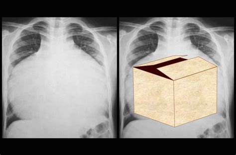 Ebstein anomaly | Radiology Reference Article | Radiopaedia.org | Ebstein's anomaly, Radiology ...