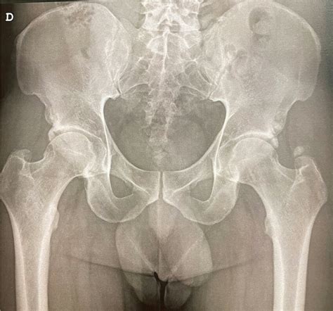 Plain X-ray of the sacroiliac joints showing signs of sacroiliitis grade 2 | Download Scientific ...