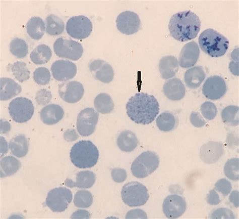 Intracellular RBC hemoglobin precipitates (Heinz bodies) in a patient ...