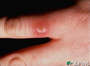 Leishmaniasis - Pictures, Symptoms, Diagnosis and Treatment