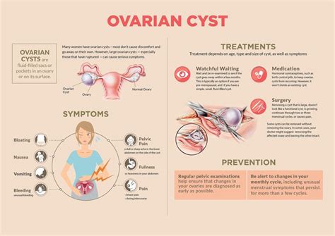 Ovarian Cyst Symptoms And Signs