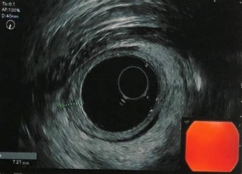 Endoscopic ultrasound finding. | Download Scientific Diagram