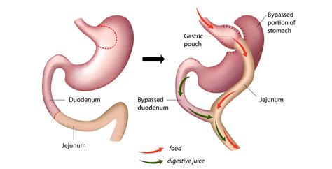 Mini Gastric Bypass (MGB) Surgery | Booking Surgery