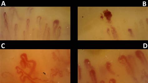 Nailfold Videocapillaroscopy in a healthy subject (A) compared with a... | Download Scientific ...