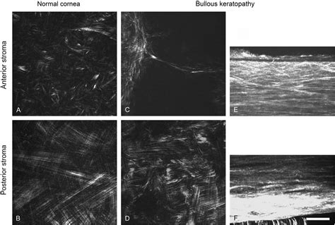 Bullous Keratopathy as a Progressive Disease: Evidence From... : Cornea