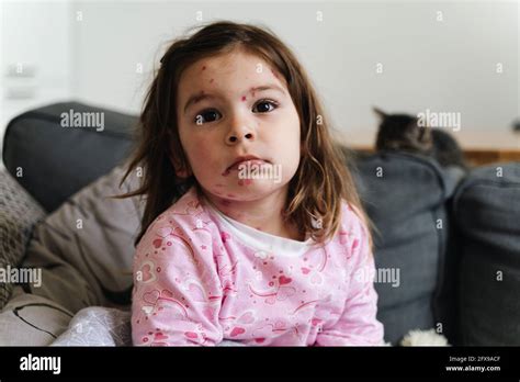 Toddler girl with chickenpox measles on the body. Varicella virus childhood contagious disease ...