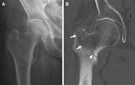 86-year-old woman with a radio-occult intertrochanteric fracture ...