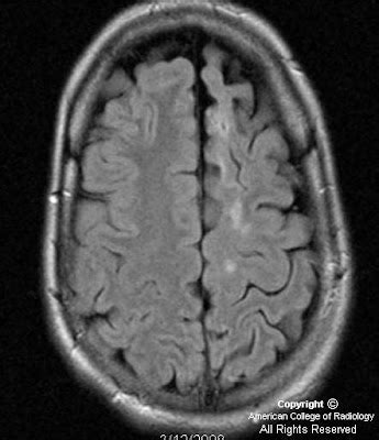 Neuroradiology On the Net: Rasmussen encephalitis