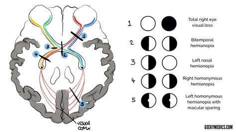 Visual Pathway and Visual Field Defects | Geeky Medics