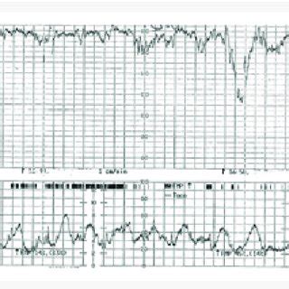 Uterine Tachysystole with CTG changes (hyperstimulation). | Download ...