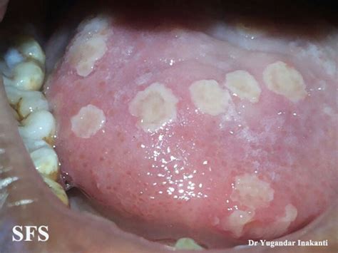 Herpetic Gingivostomatitis Gums