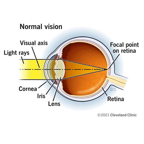 LASIK Eye Surgery: Procedure Details, Risks & Recovery (2023)