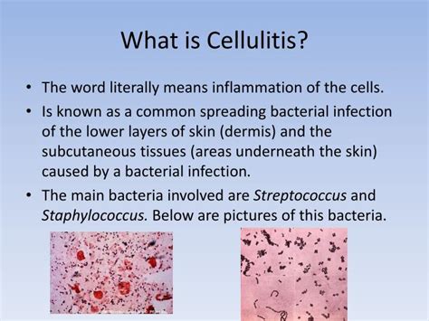 PPT - Cellulitis PowerPoint Presentation - ID:1857729