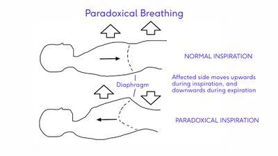 Diaphragm Anatomy and Differential Diagnosis - Physiopedia