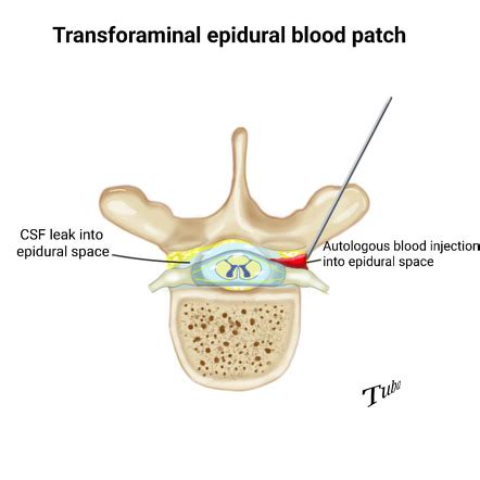 Ventral Epidural Space