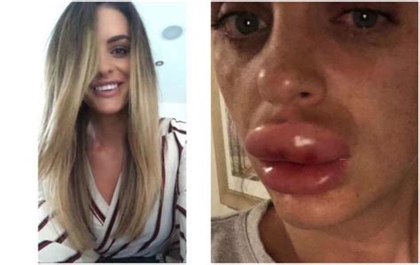 Woman’s Botched Lip Filler Procedure Becomes a Prolonged Nightmare, Goes Viral | Lip fillers ...