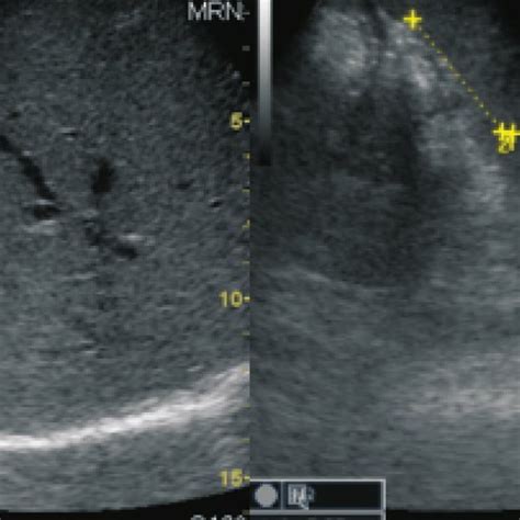 Cecum mucosal tissue with an increase in eosinophilic infiltration in ...