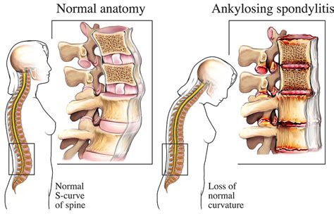 Ankylosing spondylitis – symptoms, diagnosis and treatment | healthdirect