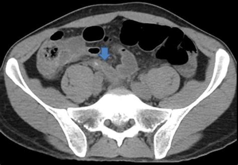 Cureus | Accuracy of Computed Tomography in Differentiating Perforated from Nonperforated ...