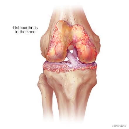 Knee Arthritis - Overview - Mayo Clinic Orthopedics & Sports Medicine