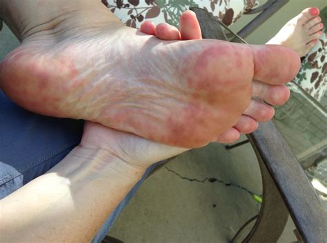 Hand, Foot, and Mouth Disease – Vanessa Marsden RN