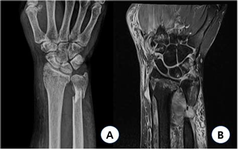 Triangular Fibrocartilage Complex Tfcc Tear Mri