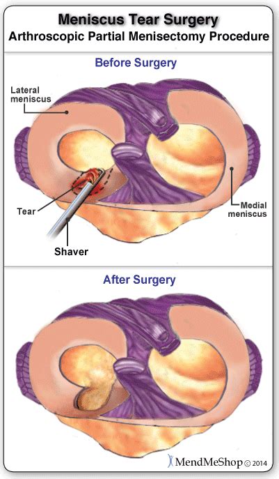 Meniscus Surgery Post-Operative Rehabilitation / Meniscectomy