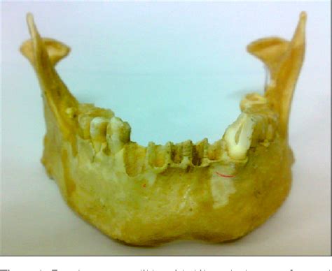 Bilateral absence of mental foramen - a rare variation | Semantic Scholar