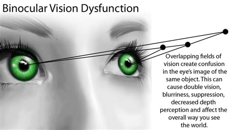 Binocular Vision Problems – Precision Family Eyecare